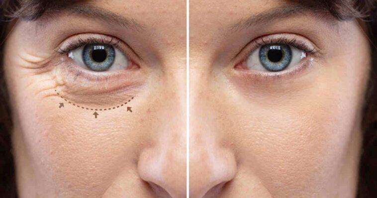 Non surgical Blepharoplasty what is it and how does it works