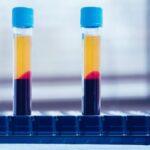 PRP: What Is It, | Risks, Results, Options and Cost PRP