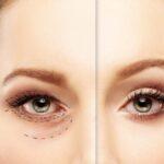 PSNA Blepharoplasty Image