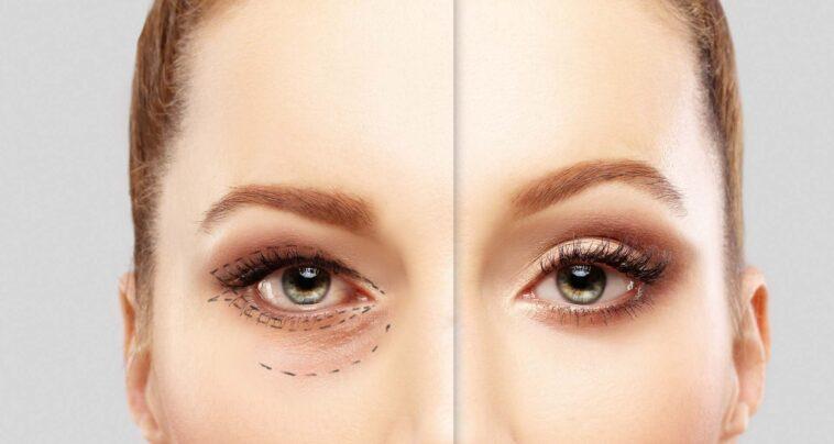 PSNA Blepharoplasty Image