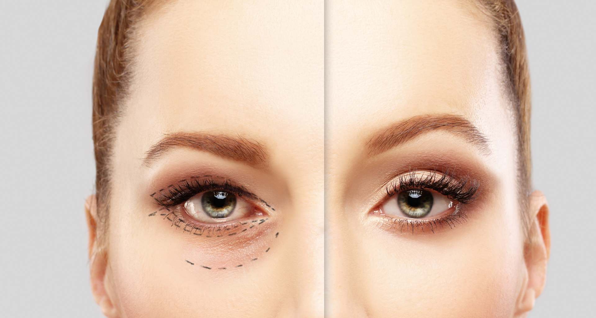 PSNA Blepharoplasty Image