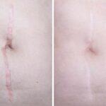 Scar Revision types objectives treatment and outlook