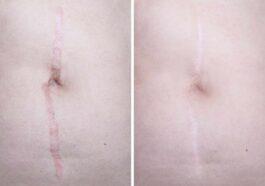 Scar Revision types objectives treatment and outlook