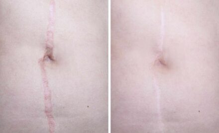 Scar Revision types objectives treatment and outlook
