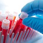 Stem cells or PRP effective treatments for scars