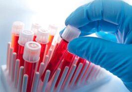 Stem cells or PRP effective treatments for scars