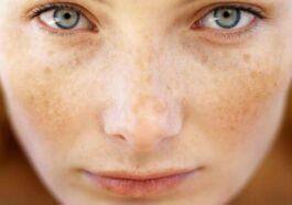 Sun hormonal changes and age causing spots on the skin