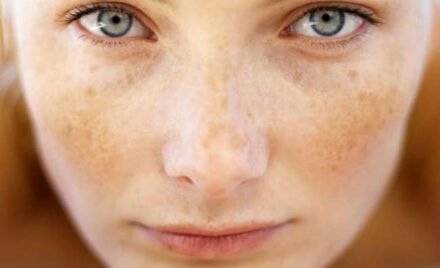 Sun hormonal changes and age causing spots on the skin