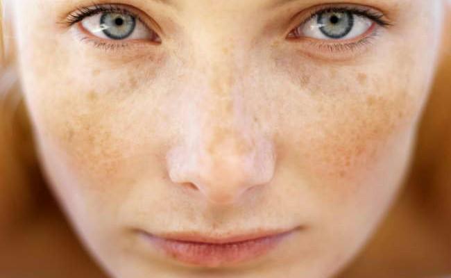 Sun hormonal changes and age causing spots on the skin