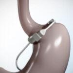 The Adjustable Gastric Band