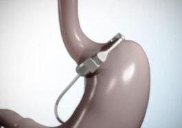 The Adjustable Gastric Band