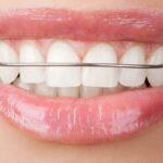 Types of orthodontics