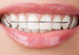 Types of orthodontics