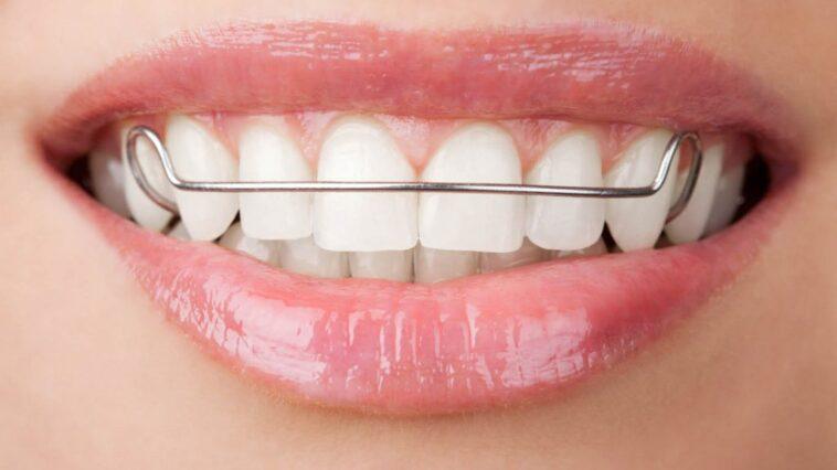 Types of orthodontics