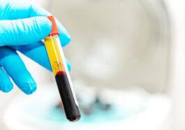 What is Platelet Rich Plasma PRP