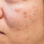 Winter the best season to treat skin blemishes