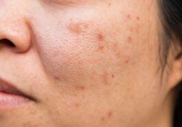 Winter the best season to treat skin blemishes