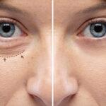 blepharoplasty