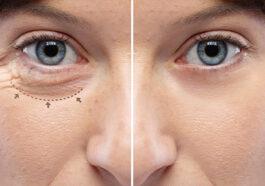 blepharoplasty