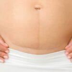 c section scar pain