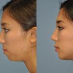 chin augmentation