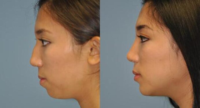 Chin Augmentation How does it work