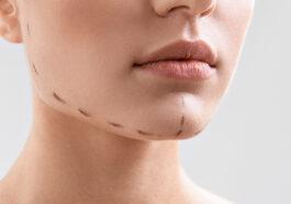 chin augmentation raleigh