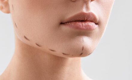 chin augmentation raleigh