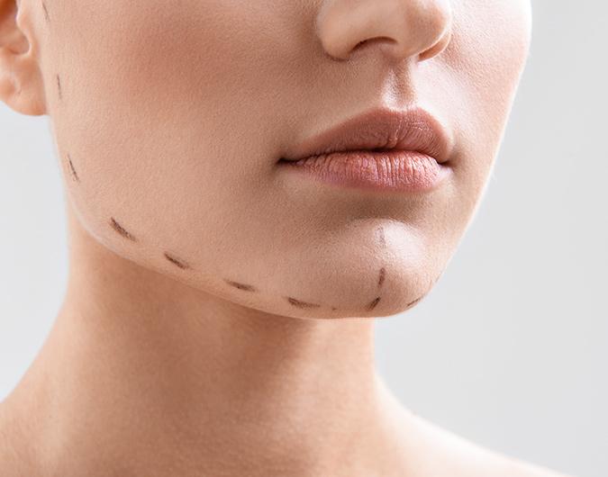 Is Mentoplasty an Asthetic Surgery Only chin augmentation raleigh