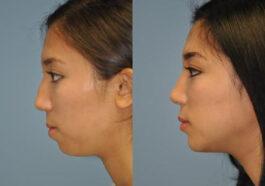 chin augmentation virginia