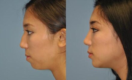 chin augmentation virginia