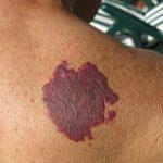 consider birthmark removal scaled
