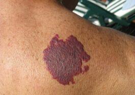 consider birthmark removal scaled