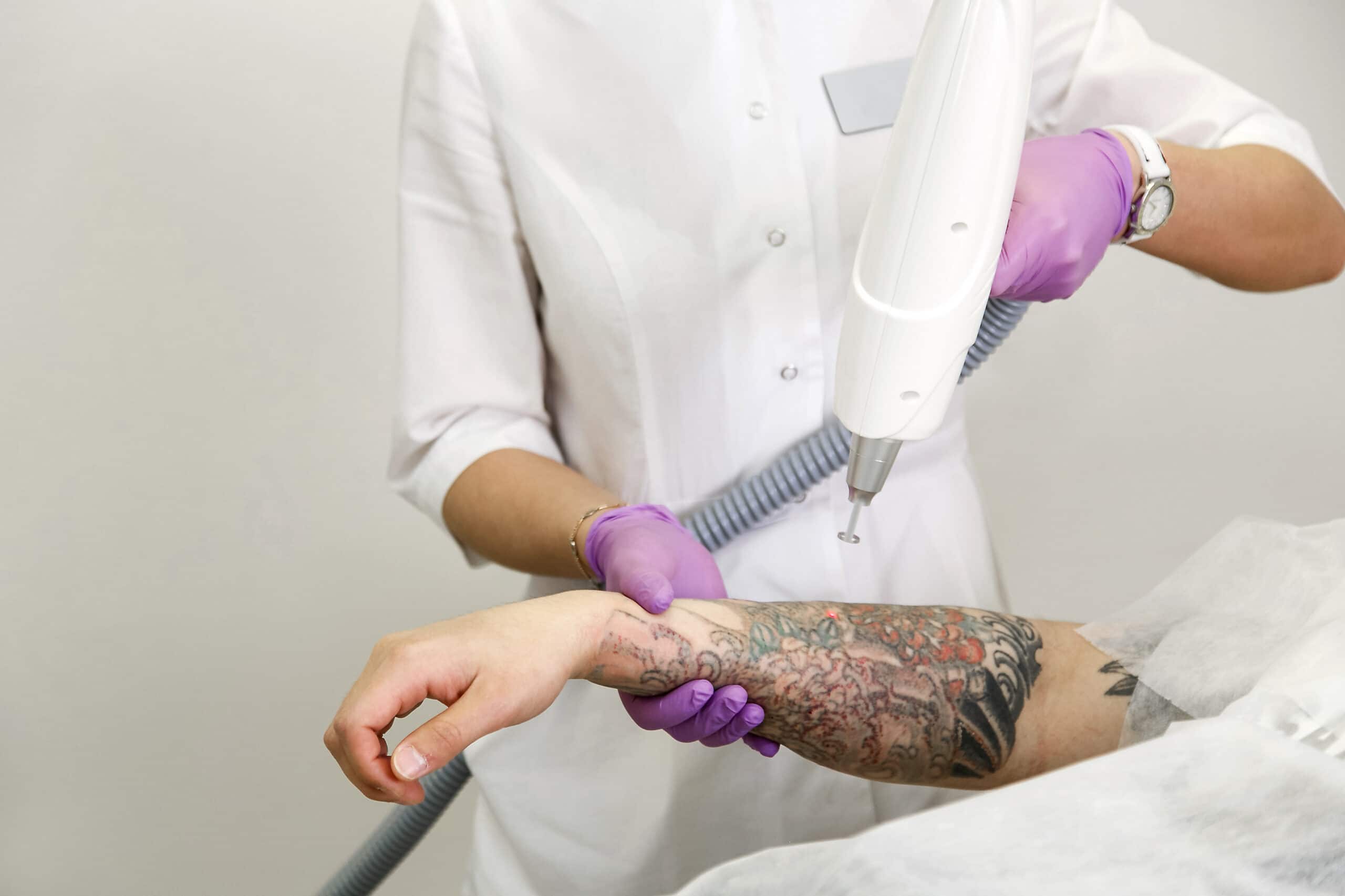 PhiRemoval for Tattoo Removal
