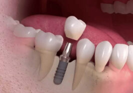 dental reconstruction 1