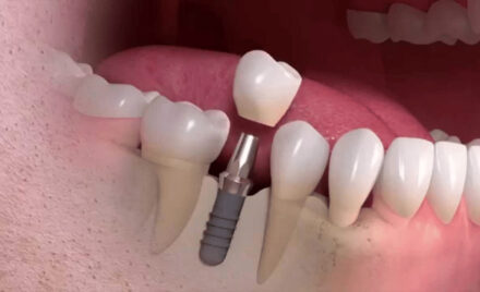 dental reconstruction 1
