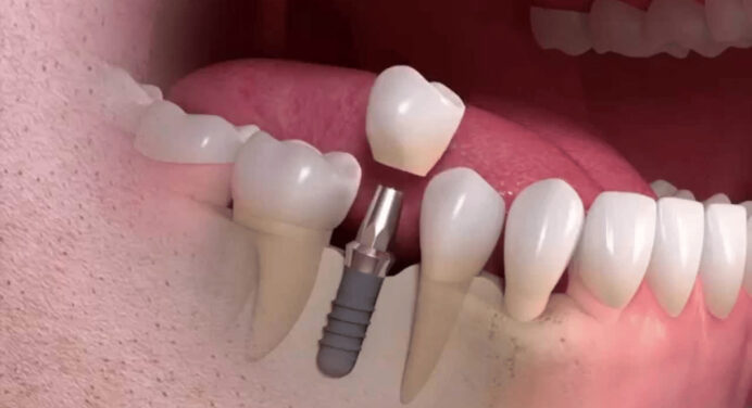 Dental Reconstruction: When Is It Necessary?