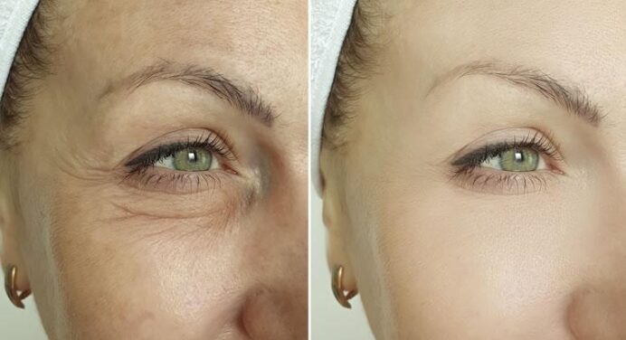 Blepharoplasty