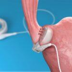 gastric bands