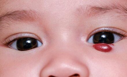 hemangioma web