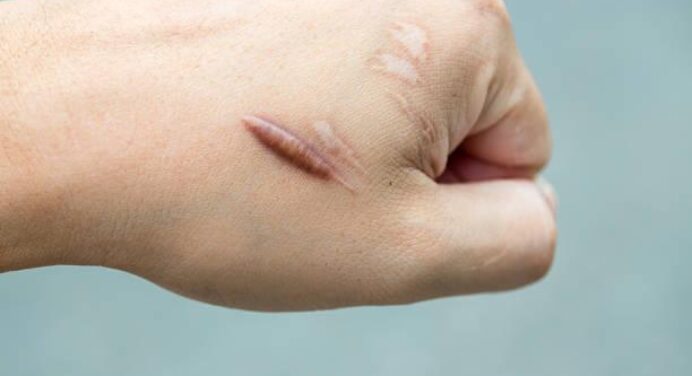 Know an Effective treatments for keloid scars