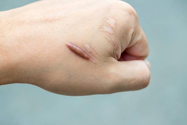 Know an Effective treatments for keloid scars istockphoto 1168150293 612x612 1