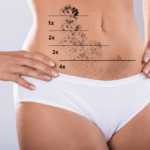 Tattoos to hide scars, stretch marks and surgeries laser hair removal huntsville al tattoo removal 85