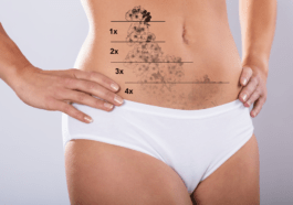 laser hair removal huntsville al tattoo removal 85