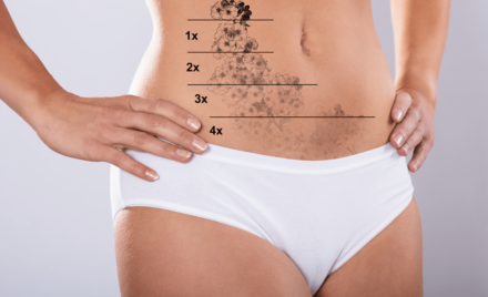 laser hair removal huntsville al tattoo removal 85