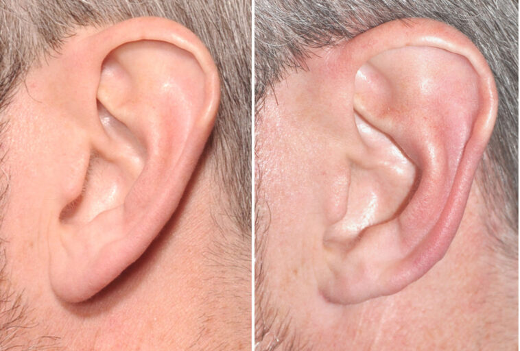 Lobulosplasty 2023: What Is It And What Is It For? lobuloplasty