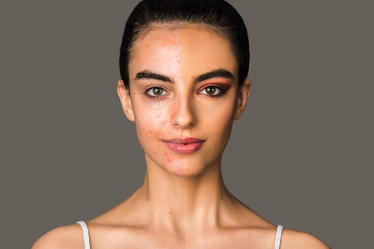 portrait woman with problematic skin with acne half face with make up