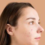 spots appear on the face