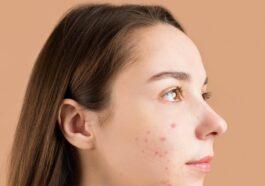 spots appear on the face