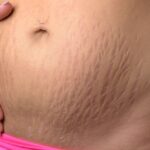 stretch Marks